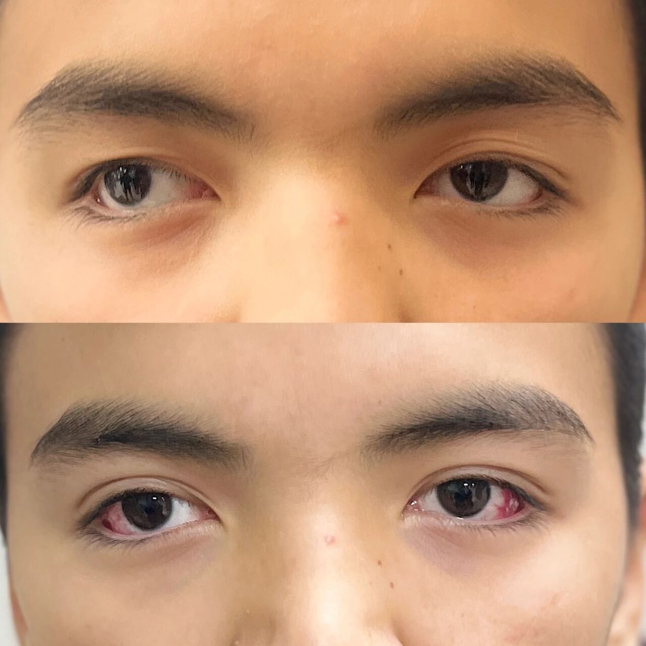 儿童斜弱视防治黄金年龄