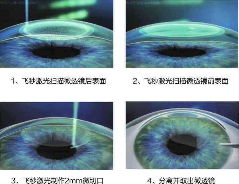 高考生摘镜必看：全飞秒4.0 vs 3.0，差别到底在哪？